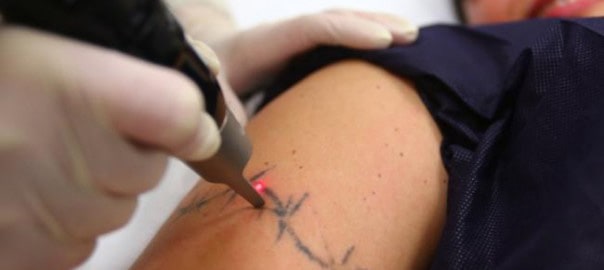Warning against dodgy tattoo removal clinics that leave patients burned and scarred