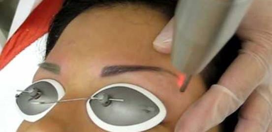 How To Safely Remove Cosmetic Tattoos | Tattoo Removal Institute