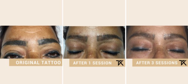 The 8 Steps to Eyebrow Tattoo Removal original before and after