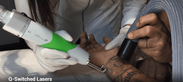 The Ultimate Guide on Laser Tattoo Removal with gloves