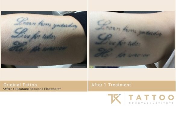 Text Arm Tattoo showing before and after progress after 1 treatment