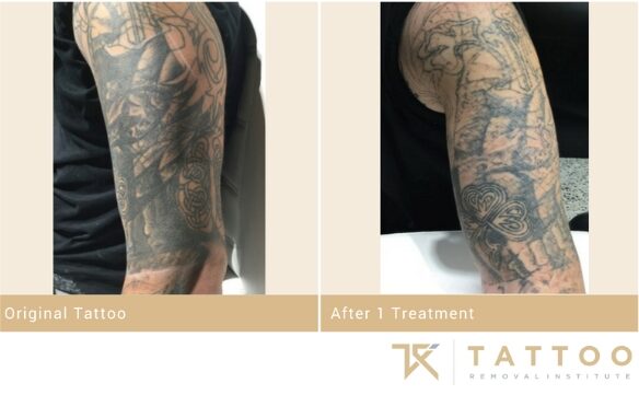 Tattoo Removal Institute | Certified Tattoo Removal Sydney