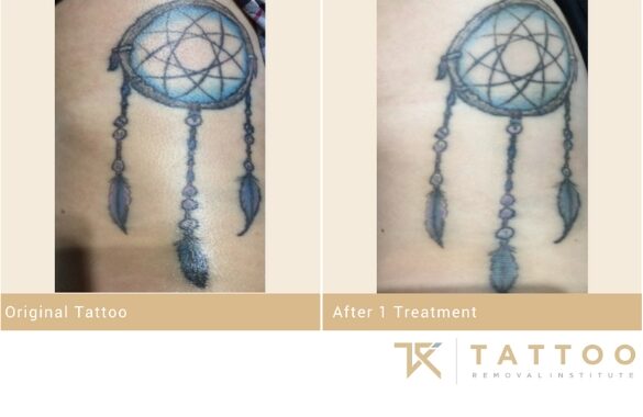 Arm Tattoo showing before and after progress after 1 treatment